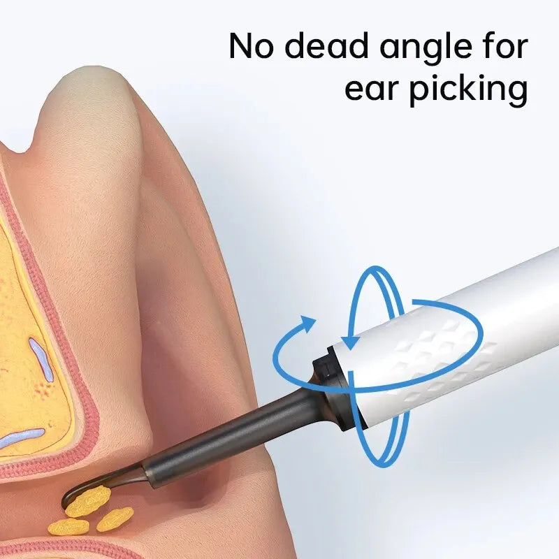 Ear Wax Removal with Camera